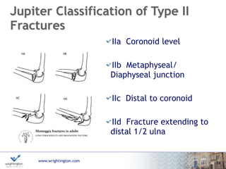 www.wrightington.com
Ring Classification
Type I
Apex anterior diaphyseal ulna fracture with anterolateral
dislocation of radiocapitellar and PRUJ
Type II
Metaphyseal buckle fractures with anterolateral
radiocapitellar dislocation (paediatric only)
Type III
Apex posterior ulna fractures with posterior dislocation
radiocapitellar joint
41
 