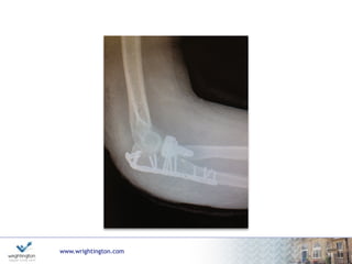 www.wrightington.com
Complication
Fixation failure - osteoporosis common
Ulna non-union
Ulno-humeral instability
Radio-ulna synostosis
54
 