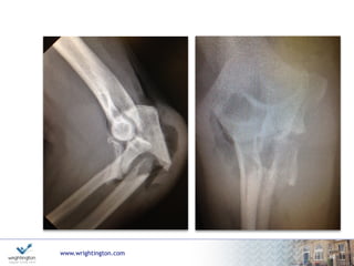 www.wrightington.com
63
Outcome Monteggia Fractures
Anterior (Bado I, Ring I)
good outcomes
less likely to involve radial head or coronoid
Posterior (Bado II, Ring III)
poor
worse if unstable coronoid fracture present (Jupiter IIa)
coronoid / radial head fractures and re-operation
associated with poorer outcome.
 