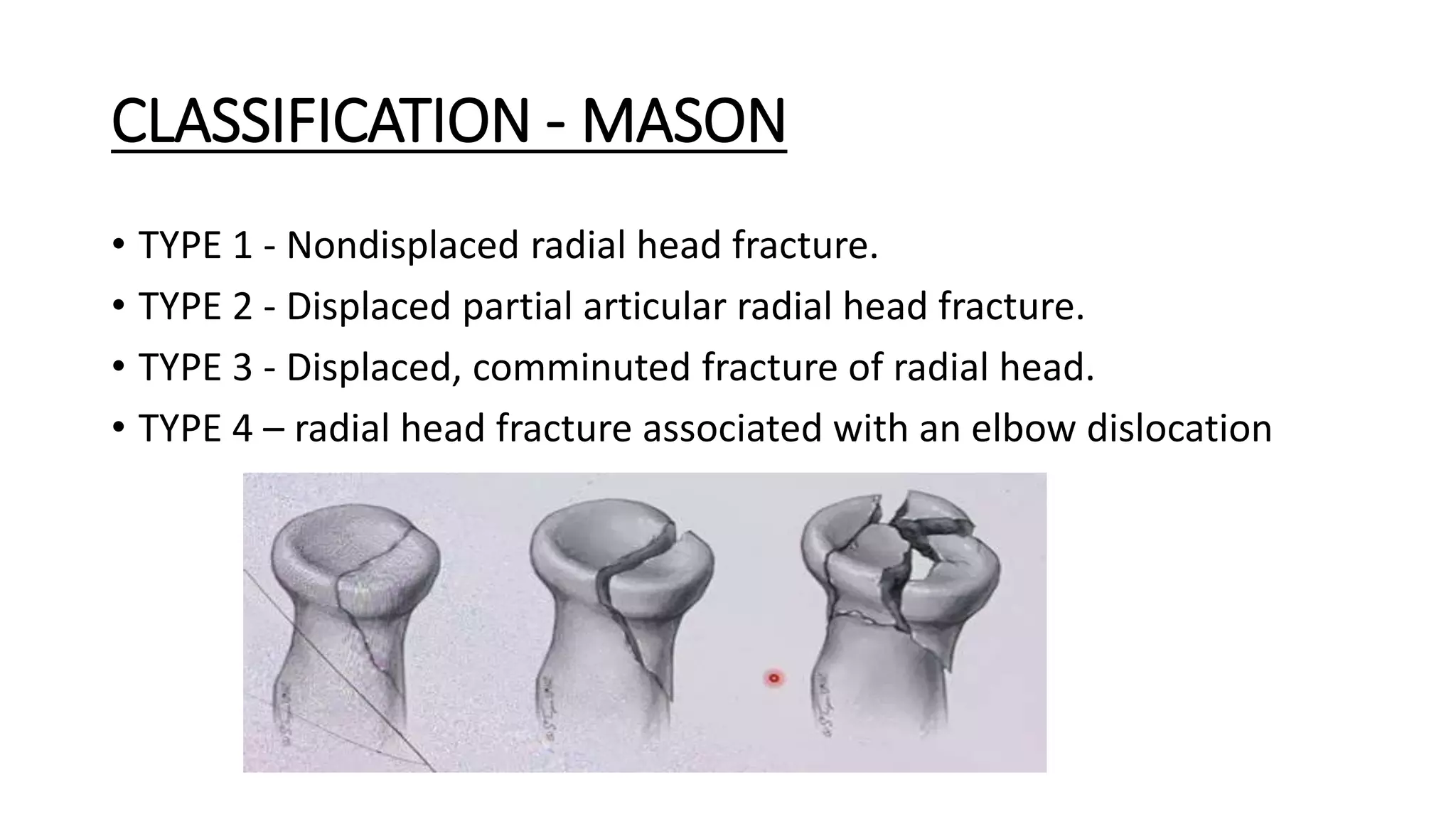 Olecronon and radial head fractures (1).pptx