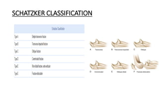 Scthker Classification Olecronon and radial head fractures (1).pptx
