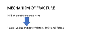 Fall Axially Olecronon and radial head fractures (1).pptx