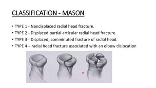 Mason Type Rsc Olecronon and radial head fractures (1).pptx