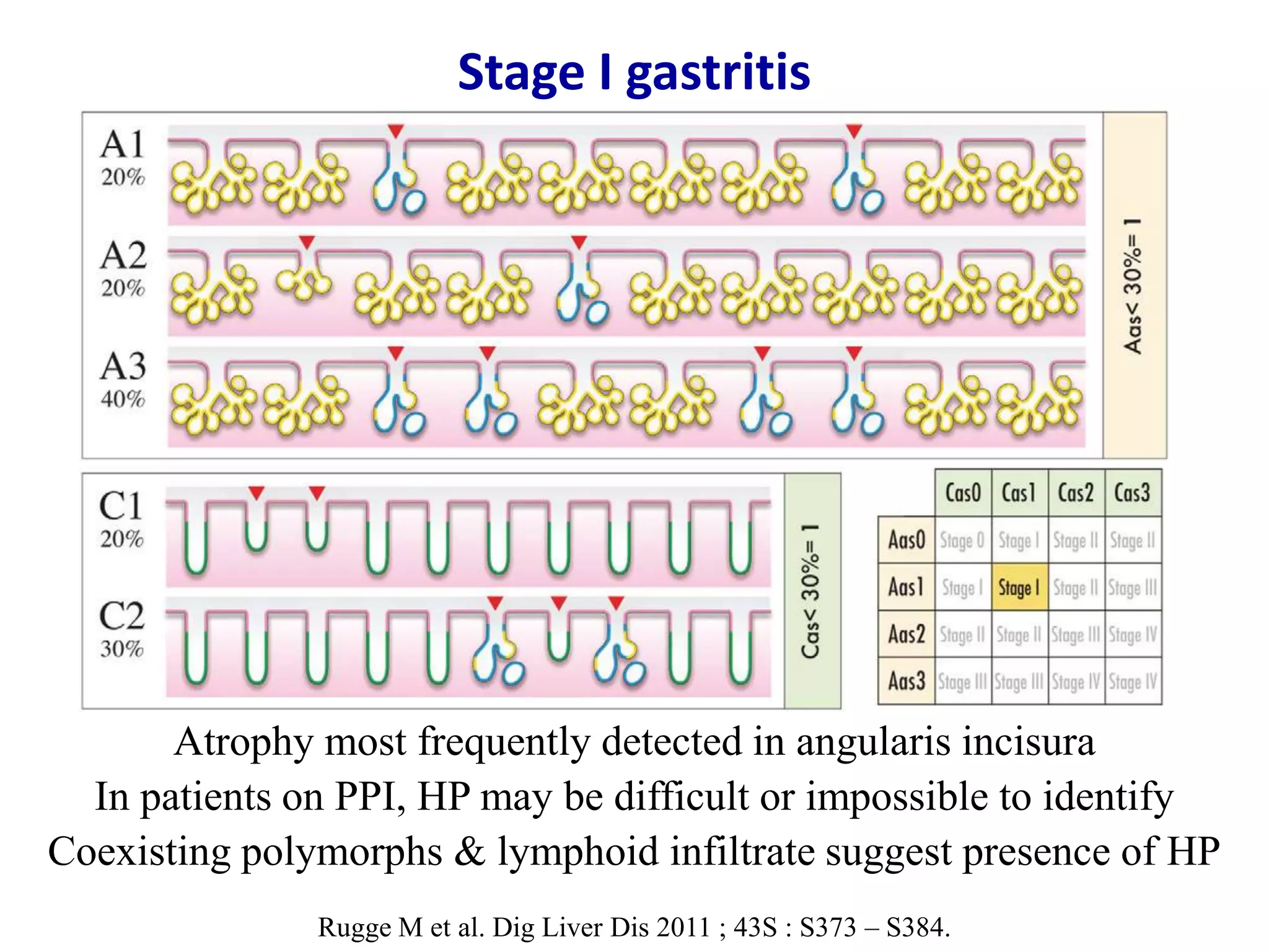 Olga staging system for diagnosis of gastritis | PPTX