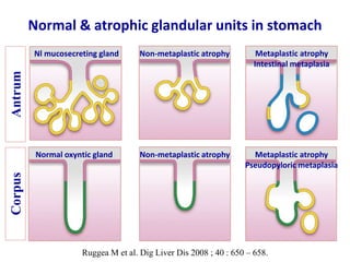 Normal & atrophic glandular units in stomach
Nl mucosecreting gland Non-metaplastic atrophy
Normal oxyntic gland Non-metaplastic atrophy Metaplastic atrophy
Pseudopyloric metaplasia
Metaplastic atrophy
Intestinal metaplasia
Ruggea M et al. Dig Liver Dis 2008 ; 40 : 650 – 658.
AntrumCorpus
 