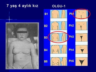 7 yaş 4 aylık kız OLGU-1
 