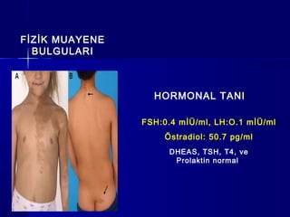 DHEAS, TSH, T4, ve
Prolaktin normal
FİZİK MUAYENE
BULGULARI
HORMONAL TANI
FSH:0.4 mİÜ/ml, LH:O.1 mİÜ/ml
Östradiol: 50.7 pg/ml
 