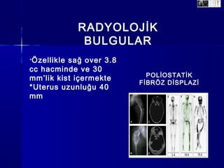 RADYOLOJİK
BULGULAR
*Özellikle sağ over 3.8
cc hacminde ve 30
mm’lik kist içermekte
*Uterus uzunluğu 40
mm
POLİOSTATİK
FİBRÖZ DİSPLAZİ
 
