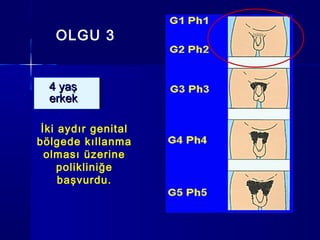 OLGU 3
4 yaş4 yaş
erkekerkek
4 yaş4 yaş
erkekerkek
İki aydır genital
bölgede kıllanma
olması üzerine
polikliniğe
başvurdu.
 