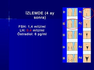 İZLEMDE (4 ay
sonra)
FSH: 1,4 mIU/ml
LH: 0.4 mIU/ml
Östradiol: 6 pg/ml
 