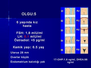 OLGU:5
FSH: 1,8 mIU/ml
LH: 0.1 mIU/ml
Östradiol: <5 pg/ml
6 yaşında kız
hasta
Kemik yaşı: 6.5 yaş
Uterus 28 mm
Overler küçük
Endometrium kalınlığı yok
17-OHP:1.8 ng/ml, DHEA:98
ng/ml
 