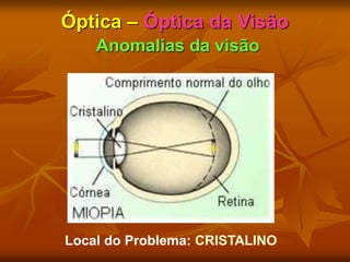 Óptica – Óptica da Visão
Anomalias da visão
Local do Problema: CRISTALINO
 