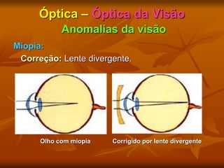 Óptica – Óptica da Visão
Anomalias da visão
Miopia:
Correção: Lente divergente.
Olho com miopia Corrigido por lente divergente
 