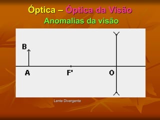 Óptica – Óptica da Visão
Anomalias da visão
Lente Divergente
 