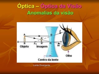 Óptica – Óptica da Visão
Anomalias da visão
Lente Divergente
 