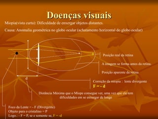 Doenças visuais
Miopia(vista curta): Dificuldade de enxergar objetos distantes.
Causa: Anomalia geométrica no globo ocular (achatamento horizontal do globo ocular)
A imagem se forma antes da retina.
Posição aparente da retina
Posição real da retina
Correção da miopia : lente divergente
F = - d
d
Foco da Lente = - F (Divergente)
Objeto para o cristalino = P
Logo.: - F = P, se e somente se, F = -d
Distância Máxima que o Míope consegue ver, uma vez que ele tem
dificuldades em se enxergar de longe
 