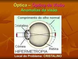 Óptica – Óptica da Visão
Anomalias da visão
Local do Problema: CRISTALINO
 