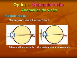 Óptica – Óptica da Visão
Anomalias da visão
Hipermetropia:
Correção: Lente Convergente
Olho com Hipermetropia Corrigido por lente convergente
 