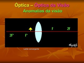 Óptica – Óptica da Visão
Anomalias da visão
Lente convergente
 