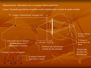 Hipermetropia: dificuldade em se enxergar objetos próximos.
Causa: Anomalia geométrica no globo ocular (achatamento vertical do globo ocular)
p = 25 cm = 0,25 m
Distância que uma pessoa
normal deveria enxergar
Posição aparente
da retina.
A imagem se
forma depois da
retina
Posição real
da retina do
hipermetrope
Este ponto que é a imagem
da lente passa a ser o
objeto para o cristalino
Correção: Lente Convergente
d
F
1
25
,
0
1
1


A imagem fornecida
pela lente é virtual
P’= d (aqui o hipermetrope consegue ver)
 
