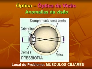 Óptica – Óptica da Visão
Anomalias da visão
Local do Problema: MÚSCULOS CILIARES
 
