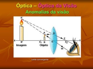 Óptica – Óptica da Visão
Anomalias da visão
Lente convergente
 