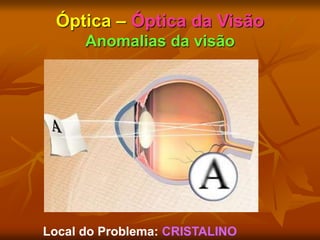 Óptica – Óptica da Visão
Anomalias da visão
Local do Problema: CRISTALINO
 