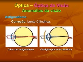 Óptica – Óptica da Visão
Anomalias da visão
Astigmatismo
Correção: Lente Cilíndrica.
Olho com astigmatismo Corrigido por lente cilíndrica
 