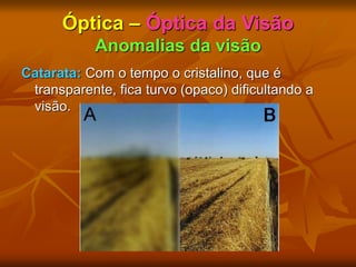 Óptica – Óptica da Visão
Anomalias da visão
Catarata: Com o tempo o cristalino, que é
transparente, fica turvo (opaco) dificultando a
visão.
 