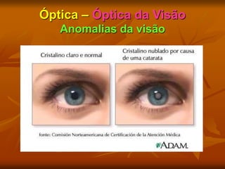 Óptica – Óptica da Visão
Anomalias da visão
 