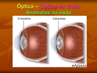 Óptica – Óptica da Visão
Anomalias da visão
 