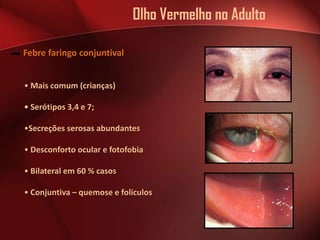 Olho Vermelho no Adulto
Febre faringo conjuntival
• Mais comum (crianças)
• Serótipos 3,4 e 7;

•Secreções serosas abundantes
• Desconforto ocular e fotofobia
• Bilateral em 60 % casos
• Conjuntiva – quemose e folículos

 