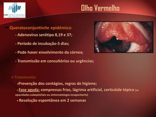 Olho Vermelho
Queratoconjuntivite epidémica:
- Adenovírus serótipo 8,19 e 37;
- Período de incubação-5 dias;
- Pode haver envolvimento da córnea;
- Transmissão em consultórios ou urgências;

• Tratamento:
•Prevenção dos contágios, regras de higíene;
• Fase aguda: compressas frias, lágrima artificial, corticóide tópico (se
opacidades subepiteliais ou sintomatologia incapacitante)
• Resolução

espontânea em 2 semanas

 