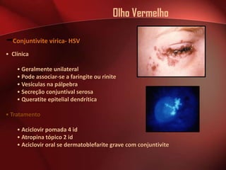 Olho Vermelho
Conjuntivite vírica- HSV
• Clínica
• Geralmente unilateral
• Pode associar-se a faringite ou rinite
• Vesículas na pálpebra
• Secreção conjuntival serosa
• Queratite epitelial dendrítica
• Tratamento

• Aciclovir pomada 4 id
• Atropina tópico 2 id
• Aciclovir oral se dermatoblefarite grave com conjuntivite

 