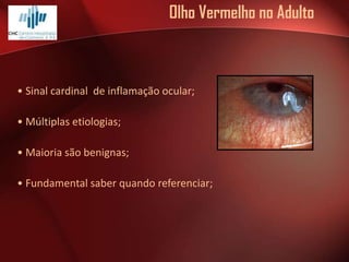 Olho Vermelho no Adulto

• Sinal cardinal de inflamação ocular;
• Múltiplas etiologias;
• Maioria são benignas;
• Fundamental saber quando referenciar;

 