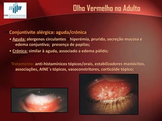 Olho Vermelho no Adulto
Conjuntivite alérgica: aguda/crónica
• Aguda: alergenos circulantes hiperémia, prurido, secreção mucosa e
edema conjuntiva; presença de papilas;
• Crónica: similar à aguda, associado a edema pálido;
Tratamento: anti-histamínicos tópicos/orais, estabilizadores mastócitos,
associações, AINE´s tópicos, vasoconstritores, corticóide tópico;

 