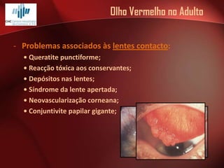 Olho Vermelho no Adulto
- Problemas associados às lentes contacto:
• Queratite punctiforme;
• Reacção tóxica aos conservantes;
• Depósitos nas lentes;
• Síndrome da lente apertada;
• Neovascularização corneana;
• Conjuntivite papilar gigante;

 