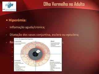 Olho Vermelho no Adulto
• Hiperémia:
- Inflamação aguda/crónica;
- Dilatação dos vasos conjuntiva, esclera ou episclera;

- Resposta inespecífica a várias agressões:
- tóxicos;
- alérgica;
- infecção;
- mecânica;

 