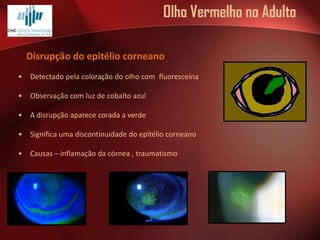 Olho Vermelho no Adulto
Disrupção do epitélio corneano
•

Detectado pela coloração do olho com fluoresceína

•

Observação com luz de cobalto azul

•

A disrupção aparece corada a verde

•

Significa uma discontinuidade do epitélio corneano

•

Causas – inflamação da córnea , traumatismo

 