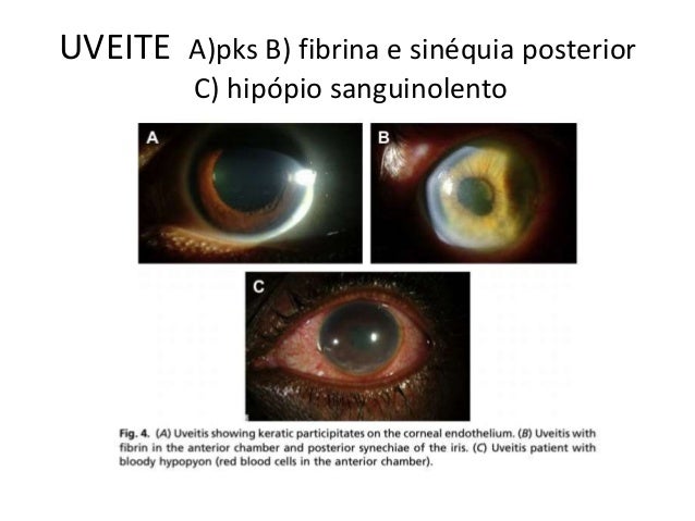 Diagnóstico Diferencial Olho Vermelho