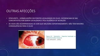 OUTRAS AFECÇÕES
• EPISCLERITE – VERMELHIDÕES EM PONTOS LOCALIZADOS DO OLHO. DIFERENCIAM-SE DAS
CONJUNTIVITES POR SEREM LOCALIZADAS E PELA AUSÊNCIA DE SECREÇÃO
• ÀS VEZES SÃO ACOMPANHADAS DE DOR QUE MELHORA ESPONTANEAMENTE. NÃO TEM MAIORES
CONSEQUÊNCIAS PARA O OLHO
 