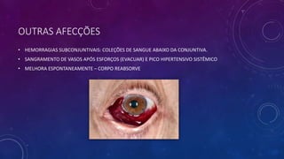 OUTRAS AFECÇÕES
• HEMORRAGIAS SUBCONJUNTIVAIS: COLEÇÕES DE SANGUE ABAIXO DA CONJUNTIVA.
• SANGRAMENTO DE VASOS APÓS ESFORÇOS (EVACUAR) E PICO HIPERTENSIVO SISTÊMICO
• MELHORA ESPONTANEAMENTE – CORPO REABSORVE
 