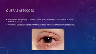 OUTRAS AFECÇÕES
• BLEFARITES: INFLAMAÇÕES CRÔNICAS DAS BORDAS PALPEBRAIS – SUPERPOPULAÇÃO DE
STAPHYLOCOCCUS
• OLHO FICA CONSTANTEMENTE AVERMELHADO POR IRRITAÇÃO DAS TOXINAS BACTERIANAS
 
