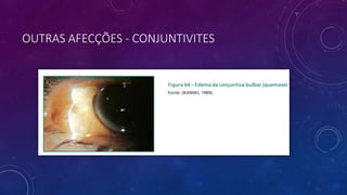 OUTRAS AFECÇÕES - CONJUNTIVITES
 