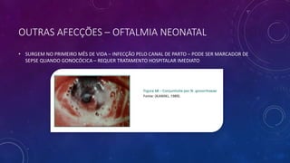OUTRAS AFECÇÕES – OFTALMIA NEONATAL
• SURGEM NO PRIMEIRO MÊS DE VIDA – INFECÇÃO PELO CANAL DE PARTO – PODE SER MARCADOR DE
SEPSE QUANDO GONOCÓCICA – REQUER TRATAMENTO HOSPITALAR IMEDIATO
 
