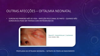 OUTRAS AFECÇÕES – OFTALMIA NEONATAL
• SURGEM NO PRIMEIRO MÊS DE VIDA – INFECÇÃO PELO CANAL DE PARTO – QUANDO NÃO
GONOCÓCICA PODE SER TRATADA COM ERITROMICINA VO
PROFILAXIA DA OFTALMIA NEONATAL – NITRATO DE PRATA AO NASCIMENTO
 
