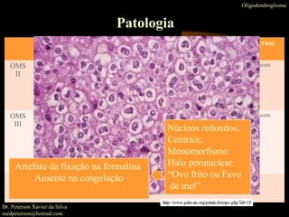 Oligodendroglioma
Patologia
Macros-
copicamente
Microscopicamente Mitose Proliferação Necrose
OMS
II
massa bem
cirunscritas, muitas
vezes com cistos;
>50% lobo frontal
•Núcleos esféricos
circundado por halo
•Rede delicada de capilares
anastomosadas
• 90% calcificações
Leve ausente ausente
OMS
III
massa bem
cirunscritas, muitas
vezes com cistos;
>50% lobo frontal
.
•Núcleos esféricos
circundado por halo
•Rede delicada de capilares
anastomosadas
• 90% calcificações
Acentuada presente ausente
OMS
IV
Núcleos redondos;
Centrais;
Monomorfismo
Halo perinuclear
“Ovo frito ou Favo
de mel”
Artefato da fixação na formalina
Ausente na congelação
Dr. Peterson Xavier da Silva
medpeterson@hotmal.com
 