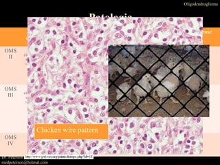 Oligodendroglioma
Patologia
Macros-
copicamente
Micros-copicamente Mitose Proliferação Necrose
OMS
II
massa bem
cirunscritas, muitas
vezes com cistos;
>50% lobo frontal
•Núcleos esféricos
circundado por halo
•Rede delicada de capilares
anastomosadas
• 90% calcificações
OMS
III
massa bem
cirunscritas, muitas
vezes com cistos;
>50% lobo frontal
.
•Núcleos esféricos
circundado por halo
•Rede delicada de capilares
anastomosadas
• 90% calcificações
OMS
IV
Chicken wire pattern
Dr. Peterson Xavier da Silva
medpeterson@hotmal.com
 