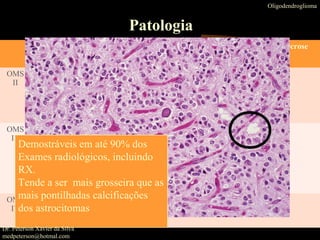 Oligodendroglioma
Patologia
Macros-
copicamente
Micros-copicamente Mitose Proliferação Necrose
OMS
II
massa bem
cirunscritas, muitas
vezes com cistos;
>50% lobo frontal
•Núcleos esféricos
circundado por halo
•Rede delicada de capilares
anastomosadas
• 90% calcificações
OMS
III
massa bem
cirunscritas, muitas
vezes com cistos;
>50% lobo frontal
.
•Núcleos esféricos
circundado por halo
•Rede delicada de capilares
anastomosadas
• 90% calcificações
OMS
IV
Demostráveis em até 90% dos
Exames radiológicos, incluindo
RX.
Tende a ser mais grosseira que as
mais pontilhadas calcificações
dos astrocitomas
Dr. Peterson Xavier da Silva
medpeterson@hotmal.com
 