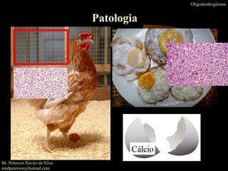 Oligodendroglioma
Patologia
Dr. Peterson Xavier da Silva
medpeterson@hotmal.com
 